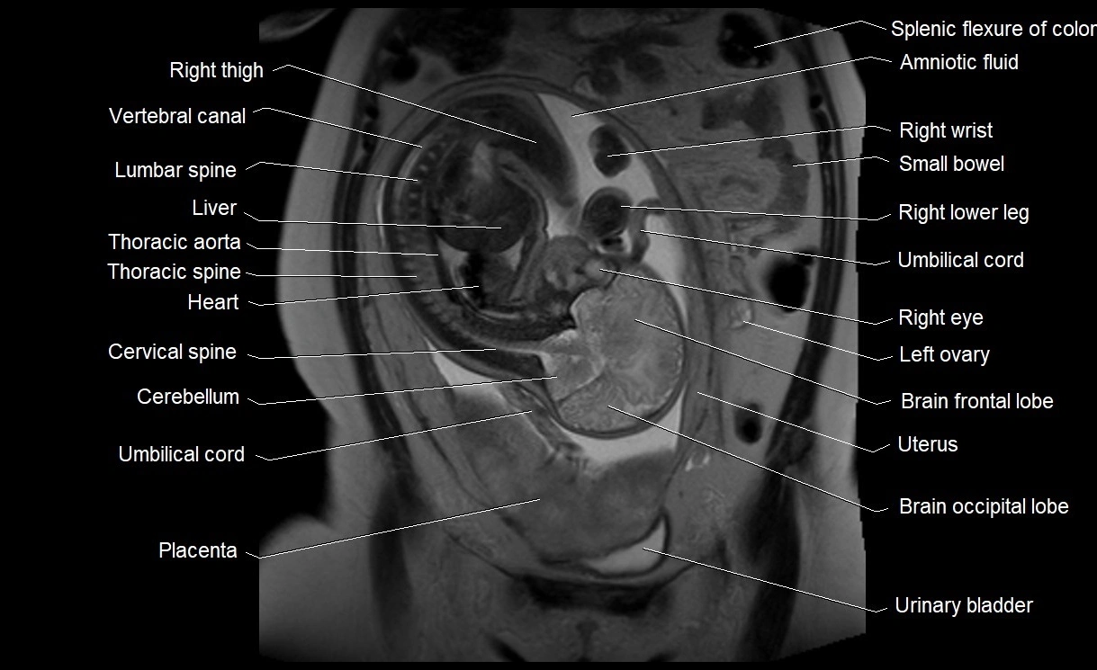 MRI Anatomy of pregnancy image 14.webp